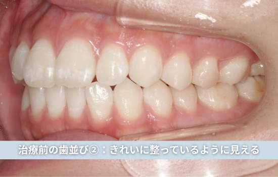 治療前の歯並び②:きれいに整っているように見える