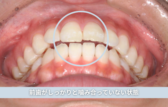前歯がしっかり噛み合っていない状態