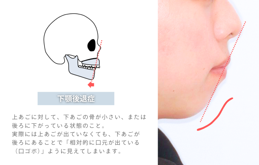 下顎後退症について