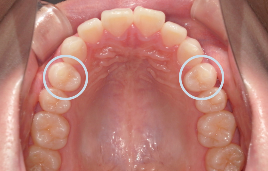症例コラム_抜歯箇所①