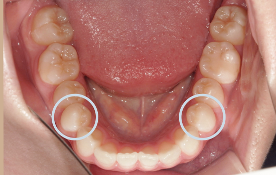 症例コラム_抜歯箇所②