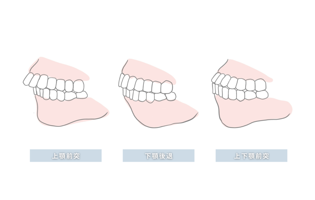 上顎前突・下顎後退・上下前突_イラスト