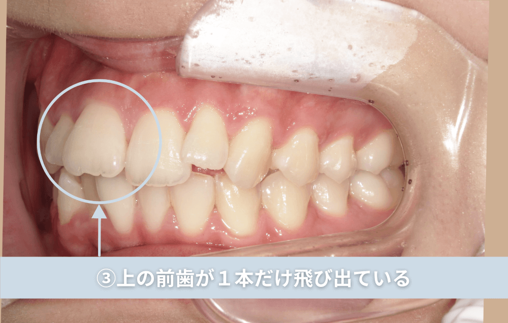 ③上の前歯が1本だけ飛び出ている