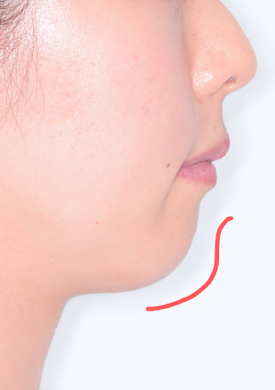 治療後症例写真_横顔