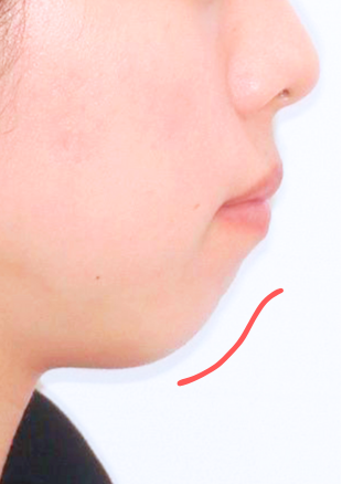 治療前症例写真_横顔