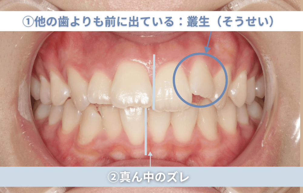 ①他の歯よりも前に出ている：叢生（そうせい）②真ん中のズレ