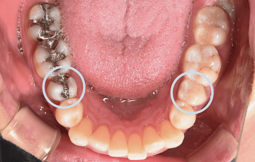 症例写真：抜歯箇所_下