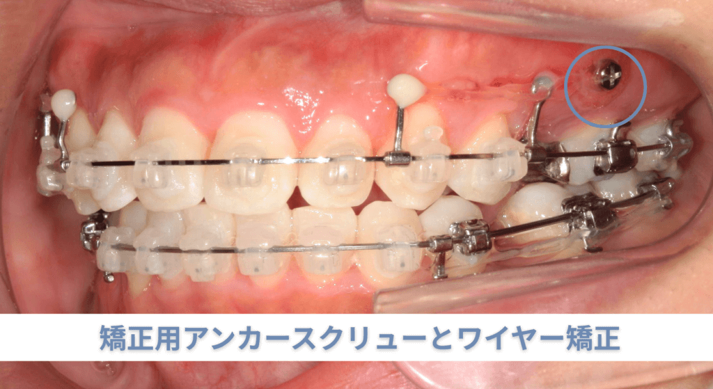 矯正用アンカースクリューとワイヤー矯正
