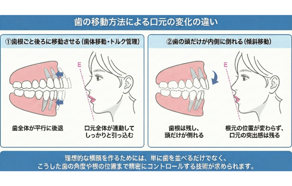 歯の移動方法による口元の変化の違い