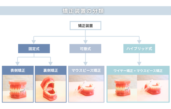 矯正装置の分類