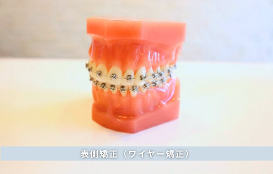 表側矯正（ワイヤー矯正）