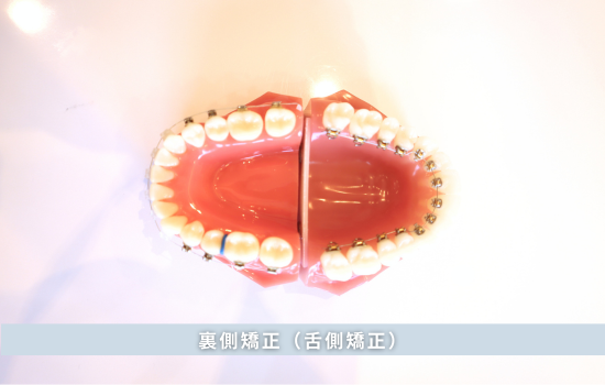 裏側矯正（舌側矯正）