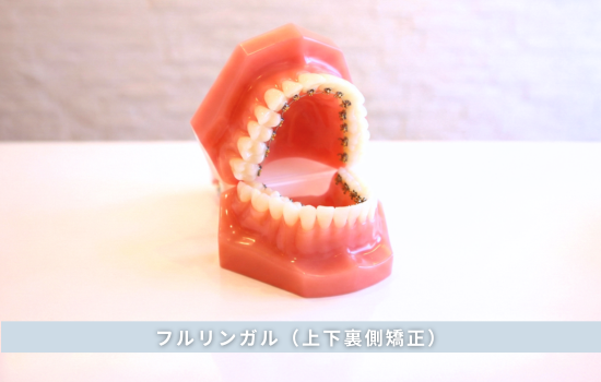 フルリンガル（上下裏側矯正）