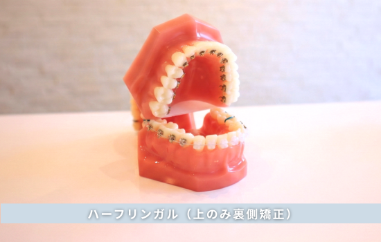 ハーフリンガル（上のみ裏側矯正）