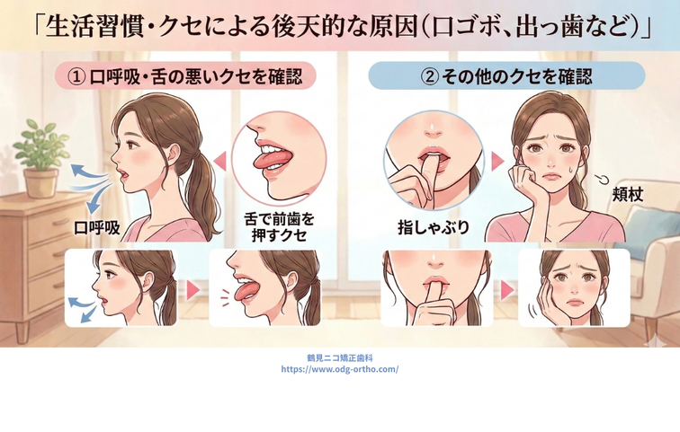 生活習慣・クセによる後天的な原因（口ゴボ、出っ歯など）