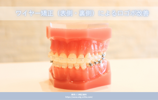 ワイヤー矯正（表側・裏側）による口ゴボ改善