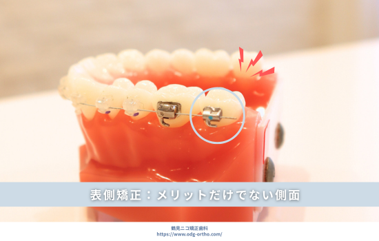 表側矯正：メリットだけではない側面