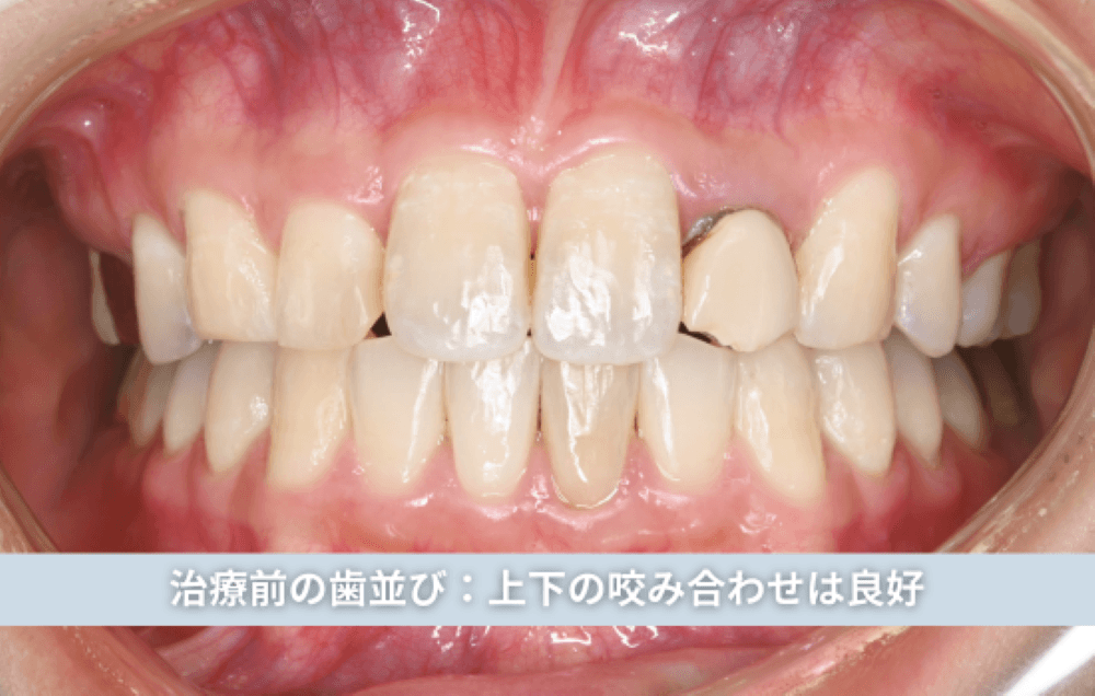 治療前の歯並び：上下の咬み合わせは良好