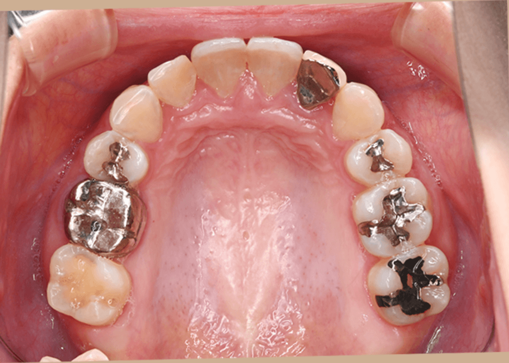 治療前症例写真_上