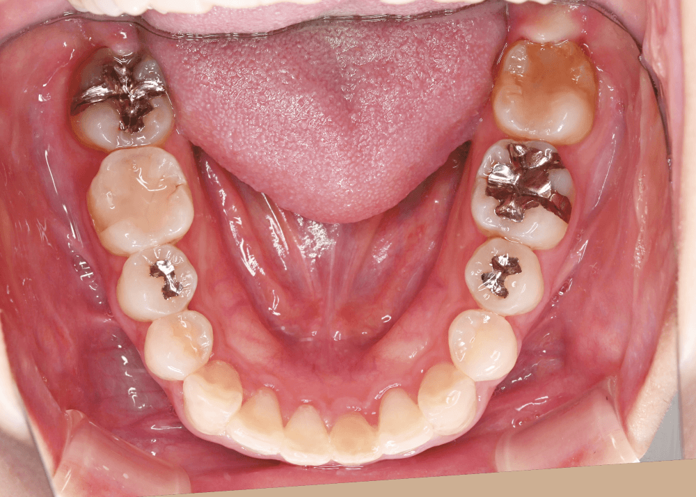 治療前症例写真_下