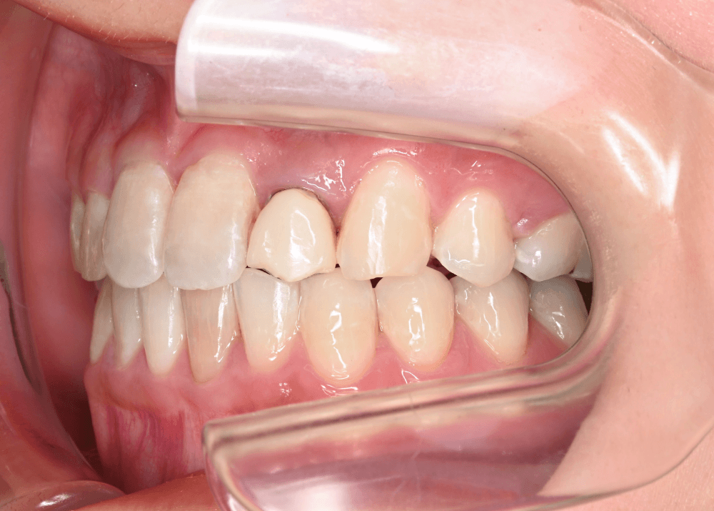 治療前症例写真_右