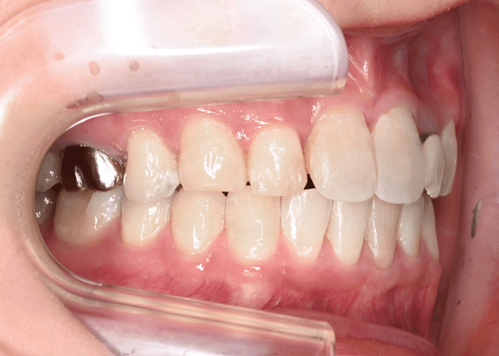 治療前症例写真_左