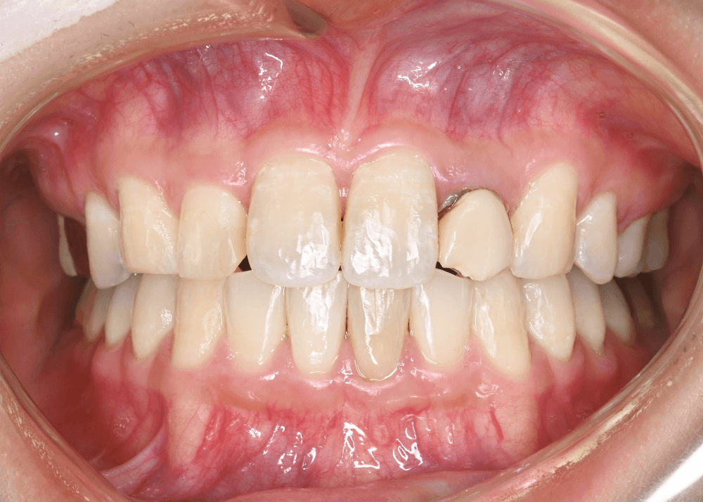 治療前症例写真_正面