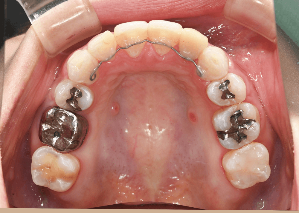 治療後症例写真_上