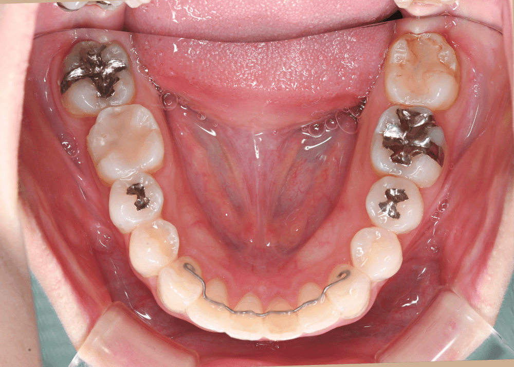 治療後症例写真_下