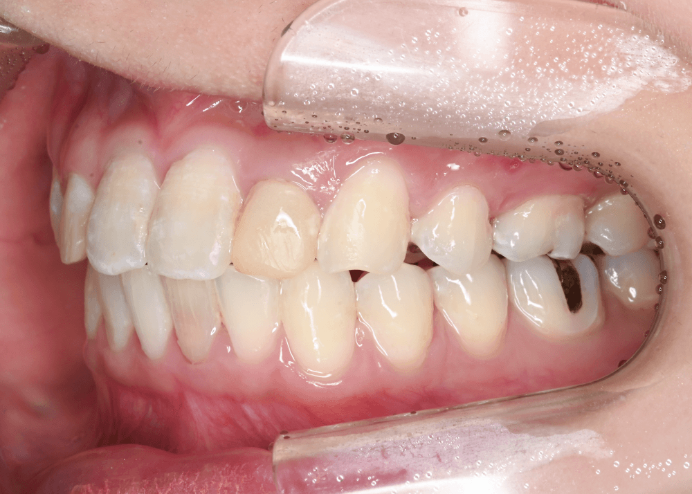 治療後症例写真_右