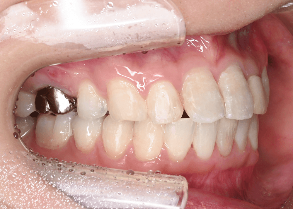 治療後症例写真_左