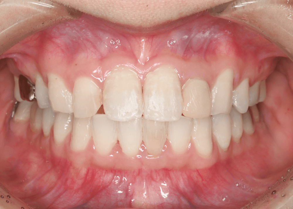 治療後症例写真_正面