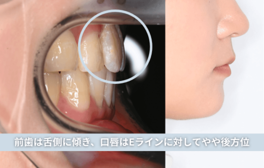 前歯は舌側に傾き、口唇はEラインに対してやや後方位
