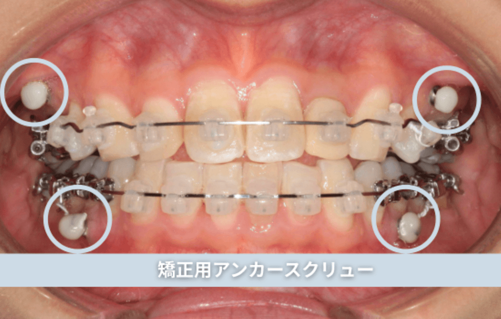 矯正用アンカースクリュー（正面）