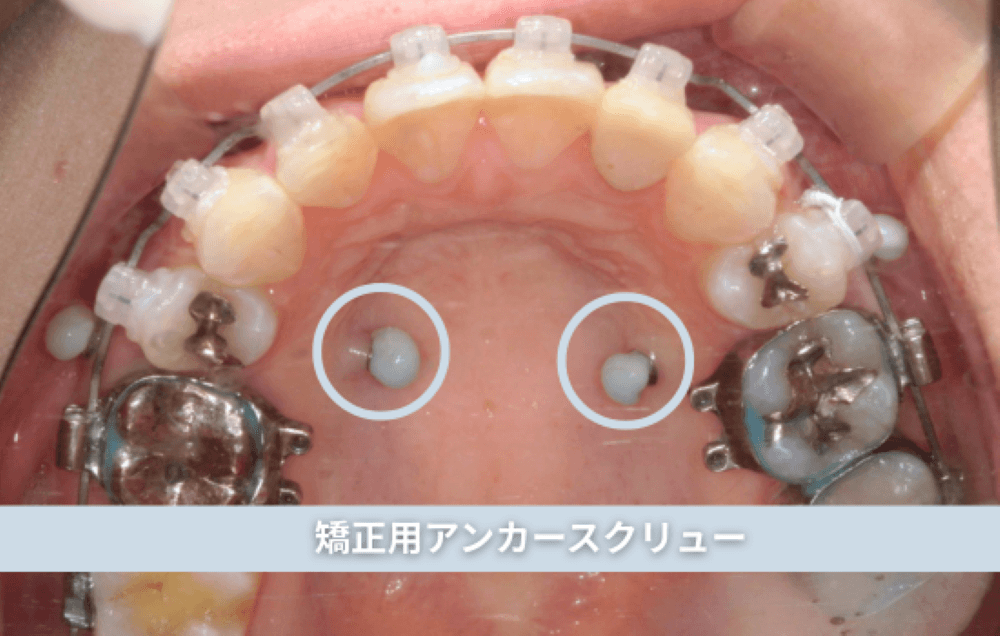 矯正用アンカースクリュー（下）