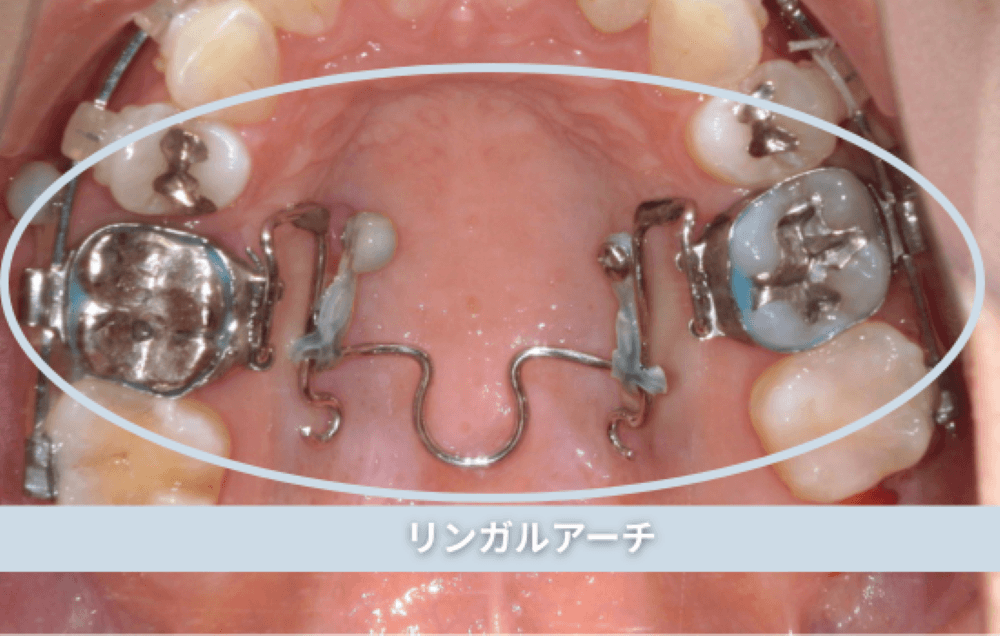 リンガルアーチ