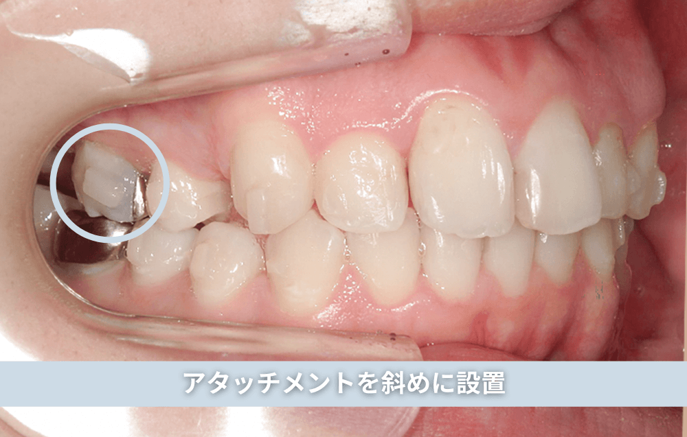 アタッチメントを斜めに設置