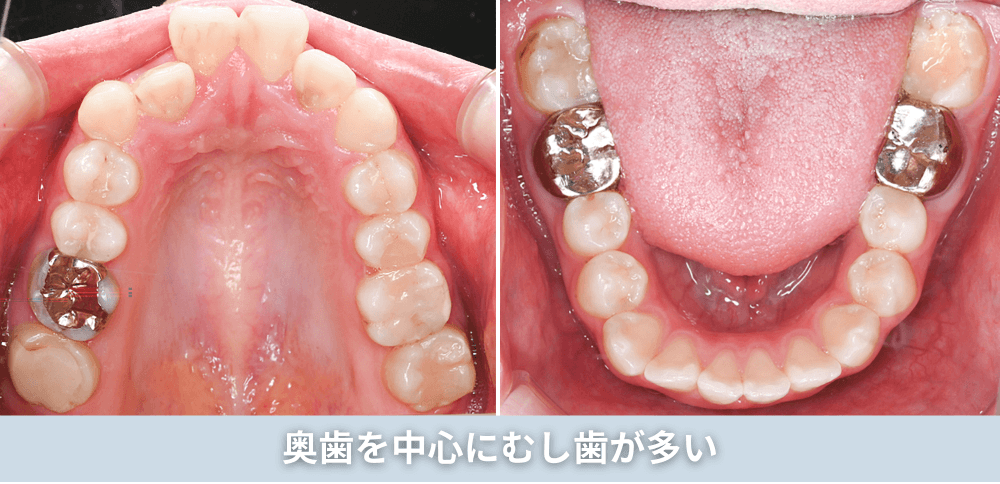 奥歯を中心にむし歯が多い