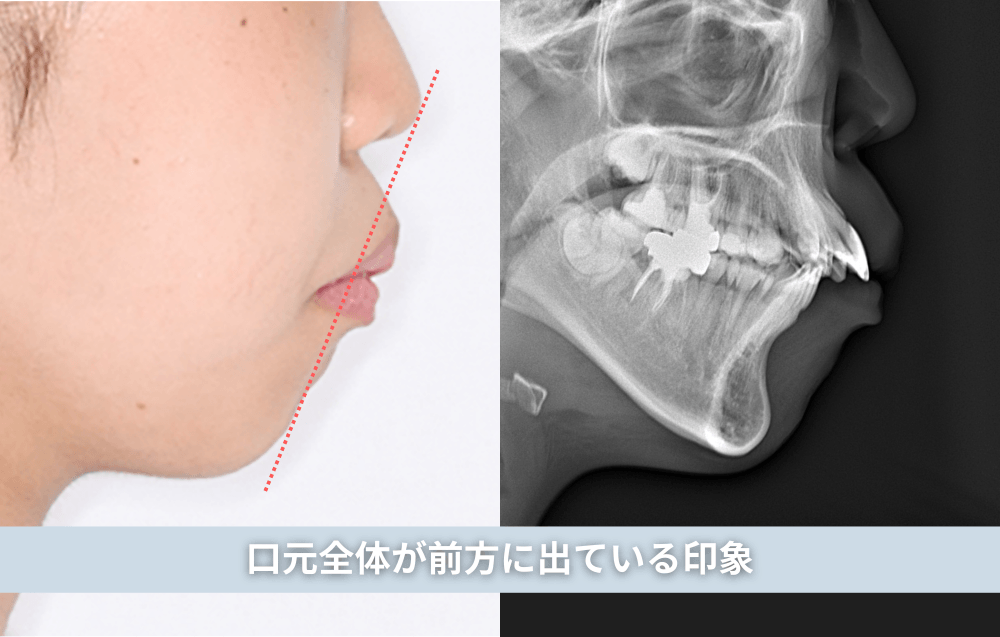 口元全体が前方に出ている印象