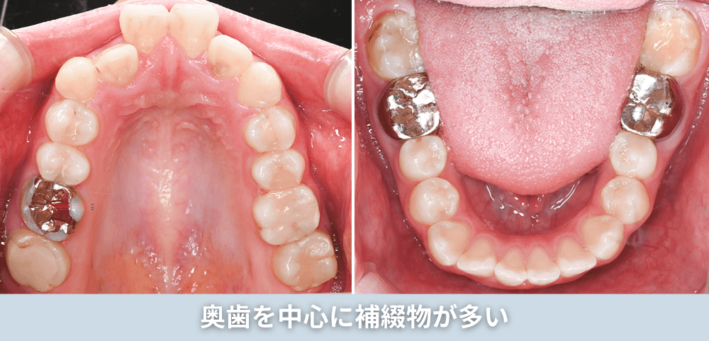奥歯を中心に補綴物が多い