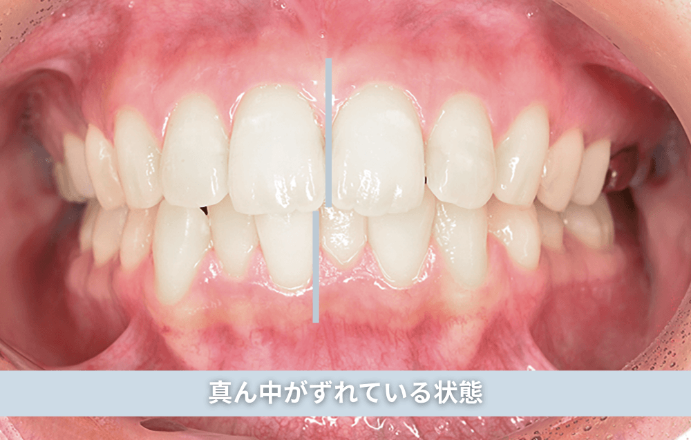 真ん中がずれている状態