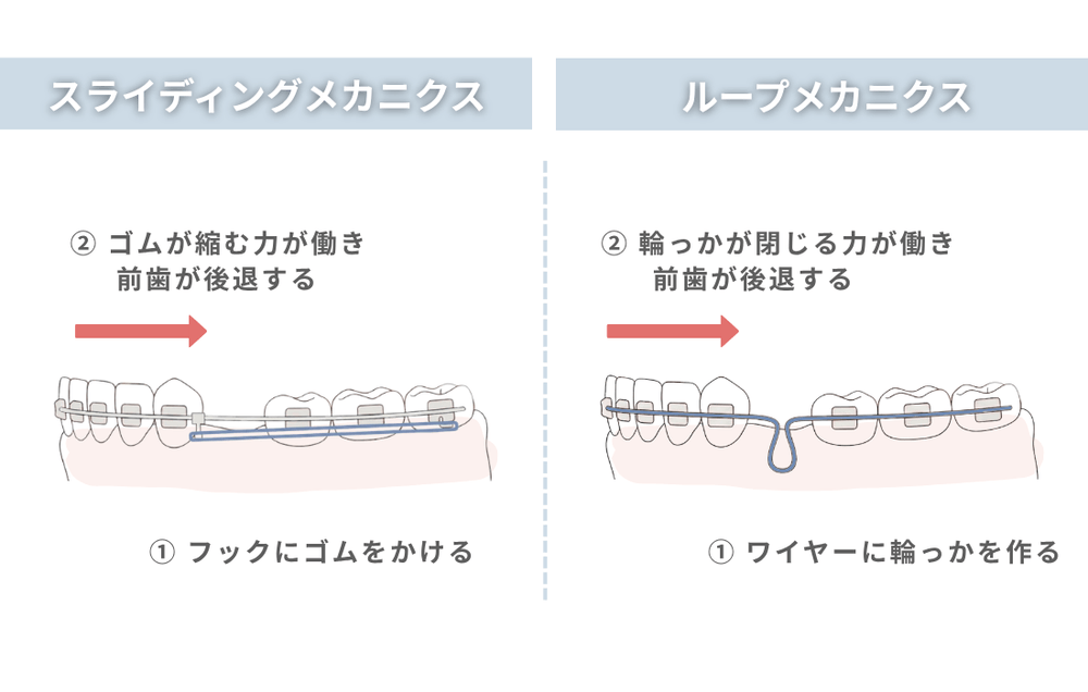 スライディングメカニクスとループメカニクス比較