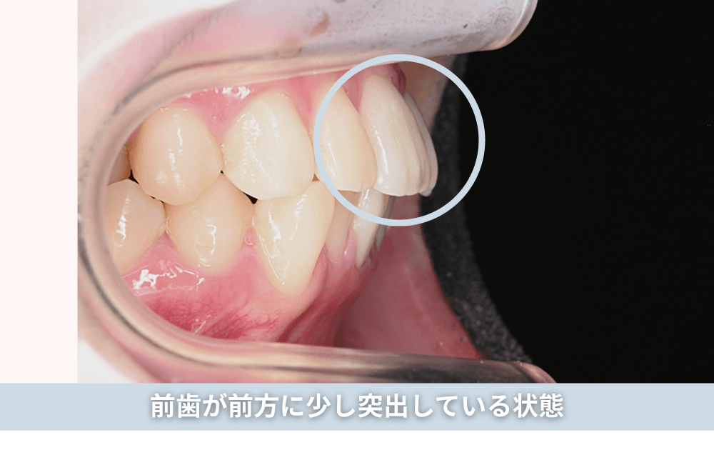 前歯が前方に少し突出している状態