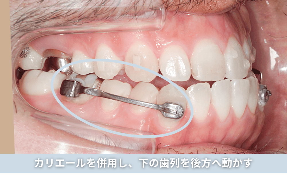 カリエールを併用し、下の歯列を後方へ動かす