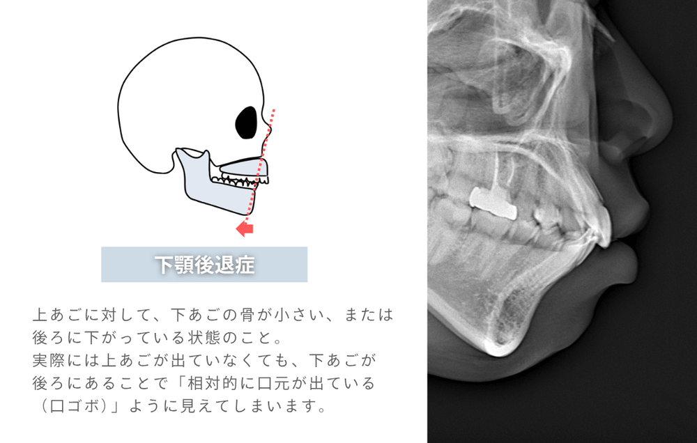 下顎後退症とは