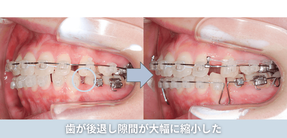 歯が後退し隙間が大幅に縮小した
