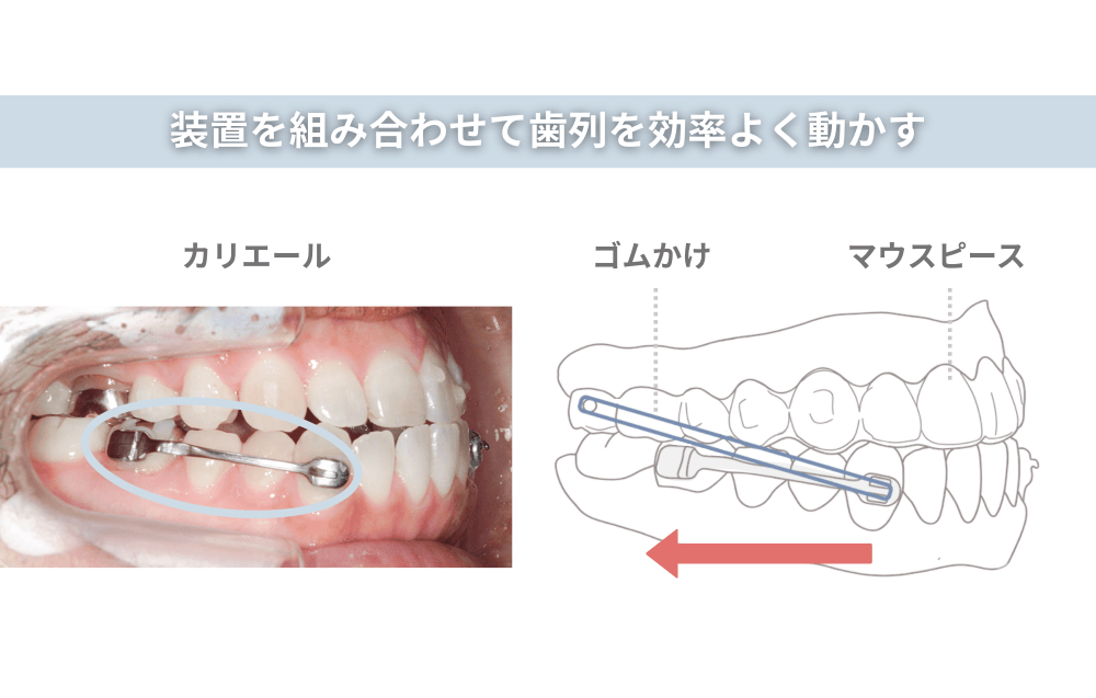 装置を組み合わせて歯列を効率よく動かす