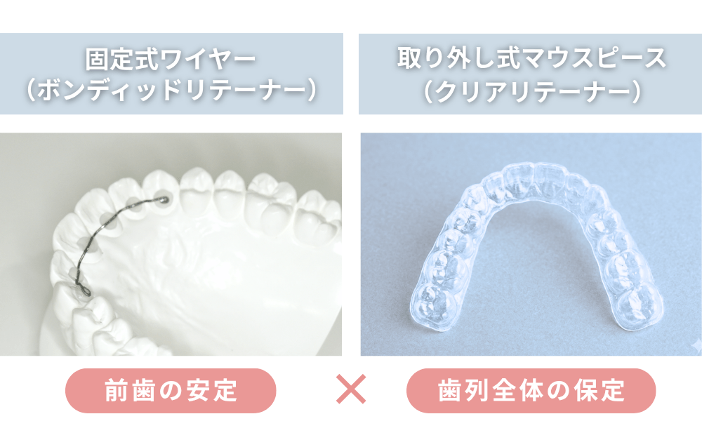 リンガルボンディドリテーナーとクリアリテーナー