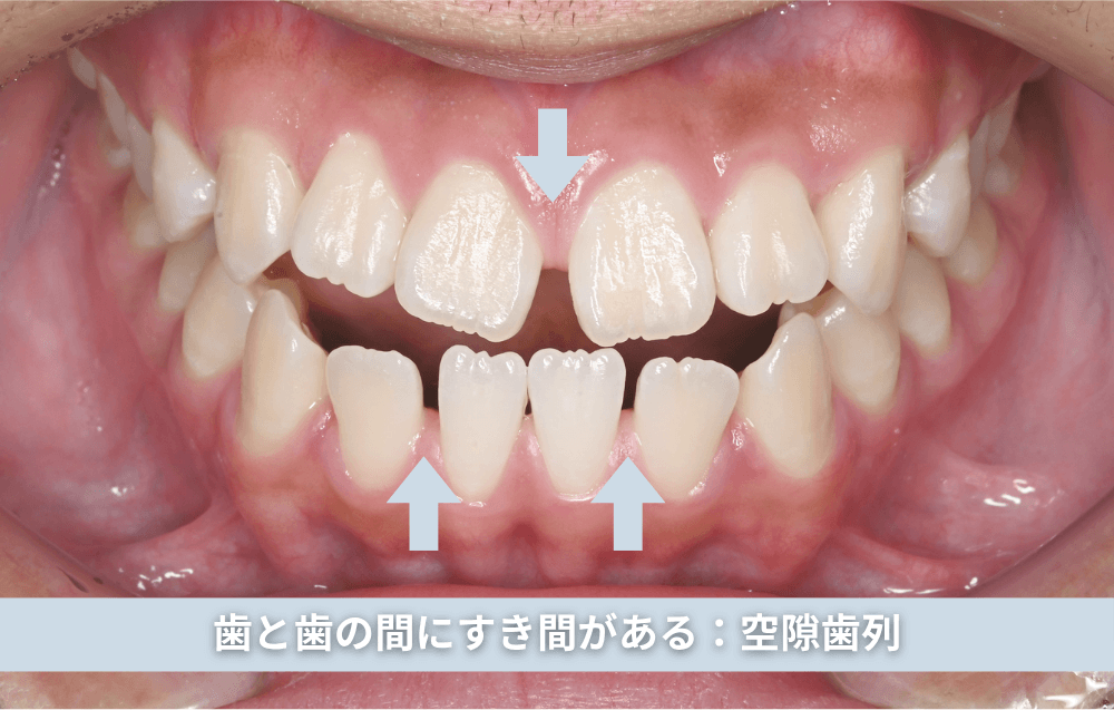 歯と歯の間にすき間がある:空隙歯列