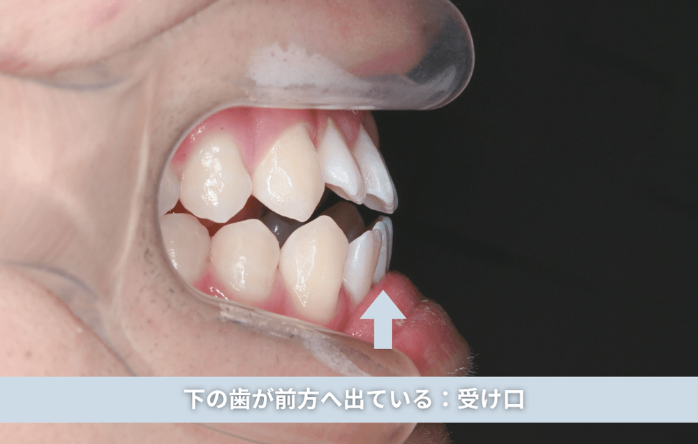 下の歯が前方へ出ている:受け口